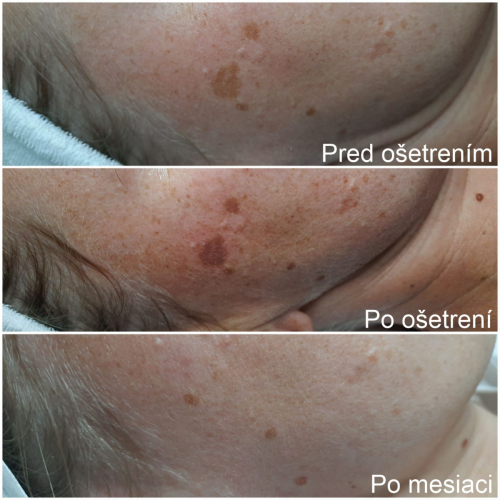 Osetrenie odstranenie pigmentu