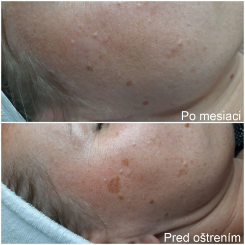 Osetrenie odstranenie pigmentu