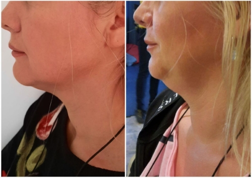 Lipolyza PB Serum pred a po